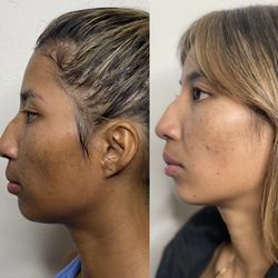 Altruistic Health and Wellness - Before + after a single face potenza
