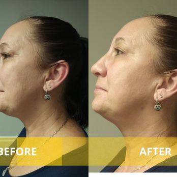 Sacred Space Day Spa - RF Skin Tightening results - Skin Care Near Me - Macon, Georgia Sacred Space Day Spa - RF Skin Tightening results - Skin Care Near Me - Macon, Georgia
