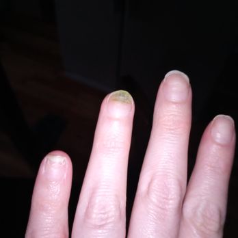 Landon Nails & Spa - My ring finger with fungus... - Nail Salons Near Me - McDonough, Georgia Landon Nails & Spa - My ring finger with fungus... - Nail Salons Near Me - McDonough, Georgia