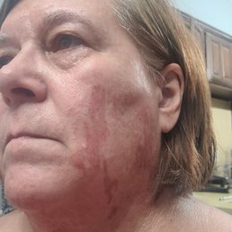 Burn streaks from the facial wax