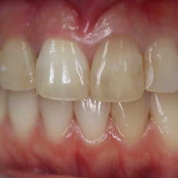 Steven M Streelman, DDS - Before photo showing dark stained teeth with patch work over many years. - General Dentistry Near Me - Oceanside, California Steven M Streelman, DDS - Before photo showing dark stained teeth with patch work over many years. - General Dentistry Near Me - Oceanside, California