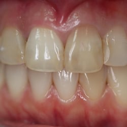 Steven M Streelman, DDS - Before photo showing dark stained teeth with patch work over many years.