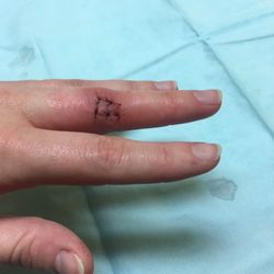 Quick Care Med - Wound after stitches