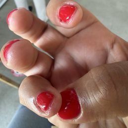 Cuts on pinky finger