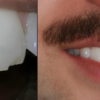 Exquisite Dentistry - After chipping my 2 front teeth, I got Zirconia veneer restoration. Couldn't be happier. (And yes, my mustache is awesome.) - Cosmetic Dentists Near Me - Los Angeles, California Exquisite Dentistry - After chipping my 2 front teeth, I got Zirconia veneer restoration. Couldn't be happier. (And yes, my mustache is awesome.) - Cosmetic Dentists Near Me - Los Angeles, California