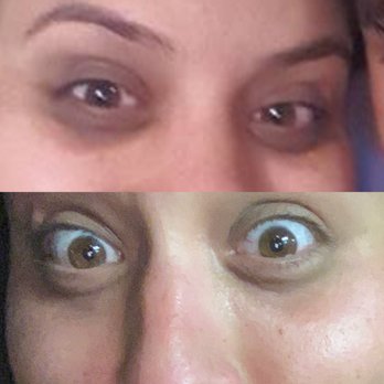 Careaga Plastic Surgery - Day before procedure and day after fillers. - Plastic Surgeons Near Me - Coral Gables, Florida Careaga Plastic Surgery - Day before procedure and day after fillers. - Plastic Surgeons Near Me - Coral Gables, Florida