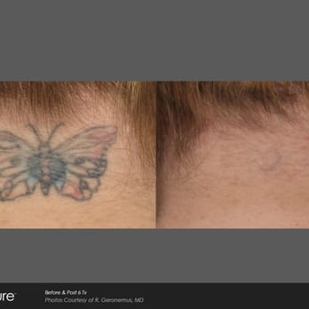 Midwest Laser Center - Tattoo Removal Near Me - Chesterfield, Missouri Midwest Laser Center - Tattoo Removal Near Me - Chesterfield, Missouri