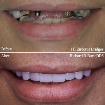 Baseline Dental Practice - 2 High Translucency Zirconia Bridges - Orthodontists Near Me - Rancho Cucamonga, California Baseline Dental Practice - 2 High Translucency Zirconia Bridges - Orthodontists Near Me - Rancho Cucamonga, California