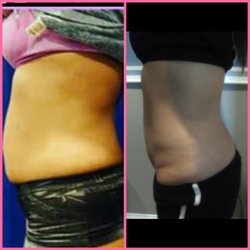 Columbus Go Lite Lipo Lounge - I lost my entire muffin top
