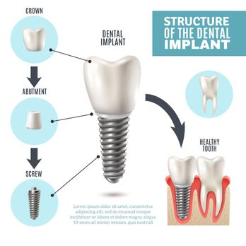 Westchester Dental - Dental implant procedure. - General Dentistry Near Me - Miami, Florida Westchester Dental - Dental implant procedure. - General Dentistry Near Me - Miami, Florida