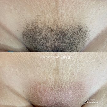 Jeanette Estiglam - Brazilian before and after - Skin Care Near Me - Pleasanton, California