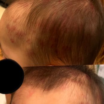 Morada Kidz Care - Photo of some of the bruises and scratches on my son's head taken in a dark-lit emergency room that I rushed him to. - Child Care & Day Care Near Me - Stockton, California Morada Kidz Care - Photo of some of the bruises and scratches on my son's head taken in a dark-lit emergency room that I rushed him to. - Child Care & Day Care Near Me - Stockton, California