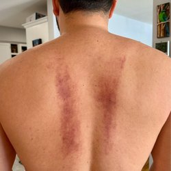 Dragon City Acupressure Massage - Bruised