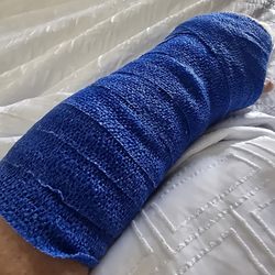 Hand & Wrist Center of Houston - This is my post revascularization surgery wrap covering a brace. Surgery was yesterday.