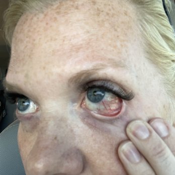 Amazing Lash Studio - This is yesterdat when i had to use prescription medication. - Eyelash Service Near Me - Gilbert, Arizona Amazing Lash Studio - This is yesterdat when i had to use prescription medication. - Eyelash Service Near Me - Gilbert, Arizona