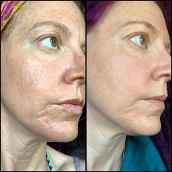 LET'S FACE IT botox & more - after 1st treatment on left after 6th treatment on right - Medical Spas Near Me - Ventnor City, New Jersey LET'S FACE IT botox & more - after 1st treatment on left after 6th treatment on right - Medical Spas Near Me - Ventnor City, New Jersey