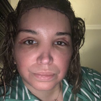 Athré Facial Plastics - The healing process. - Cosmetic Surgeons Near Me - Houston, Texas Athré Facial Plastics - The healing process. - Cosmetic Surgeons Near Me - Houston, Texas
