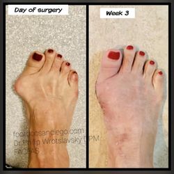 Advanced Foot and Ankle Center of San Diego - Before and after Bunion Correction