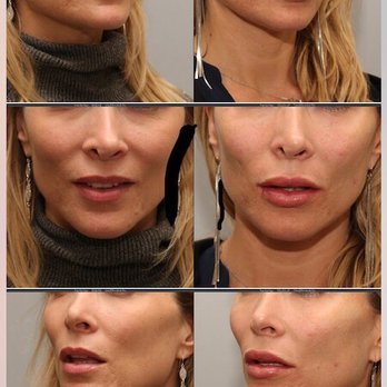 Lumier Medical - This was taken straight after my procedures (right side) Love his work!! He made my lips full and sultry without the dreaded "trout pout". - Medical Spas Near Me - Torrance, California Lumier Medical - This was taken straight after my procedures (right side) Love his work!! He made my lips full and sultry without the dreaded "trout pout". - Medical Spas Near Me - Torrance, California