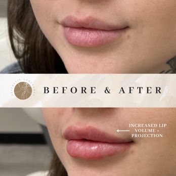 Aesthetic Sanctuary - Increased lip volume + projection - Medical Spas Near Me - Honolulu, Hawaii Aesthetic Sanctuary - Increased lip volume + projection - Medical Spas Near Me - Honolulu, Hawaii