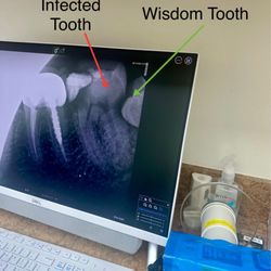 1488 Dental - X-ray of infected tooth and wisdom tooth