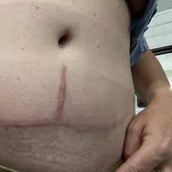 Regional Plastic Surgery Center - Almost 2 years post op