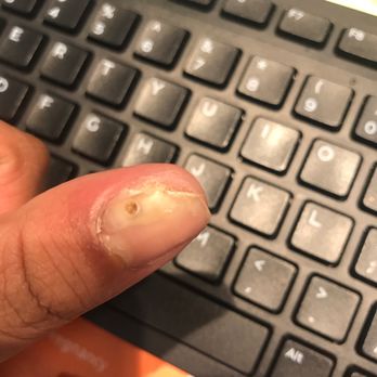Gallery Nails and Spa - The infection his dirty employees gave me with their dirty tools. - Nail Salons Near Me - Burbank, California