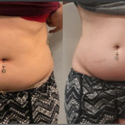 Inspire Beauty - Real Client...Real Result! 6 treatments!