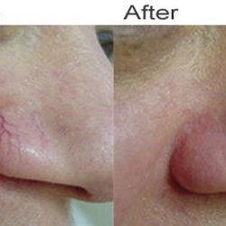 Mark Owsley - Reflections Aesthetic Spa - We have lasers for both hair removal and vascular veins!