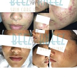 The Beez Kneez Skin Care and Acne Clinic - Before & after