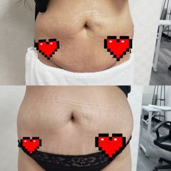Body By Nickie - Cavitation/vaccum therapy/ Radio Frequency/laser lipo