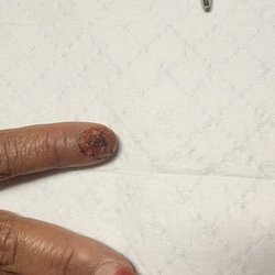 Atlanta Hand Specialist - 4 days after surgery.