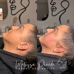Besos Aesthetics - Jaw line Filler