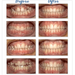 VivaDent - Teeth straightening (braces)