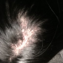 After perm straight this is what happened got my hair burnt got a bald spot..very poor job so dis appointed and mad with what they did