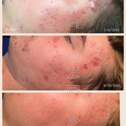 The Acne Lab