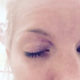 This is what happens if you get your eye brows waxed there.... A big bruise. DO NOT come to this salon! This is what happens if you get your eye brows waxed there.... A big bruise. DO NOT come to this salon!