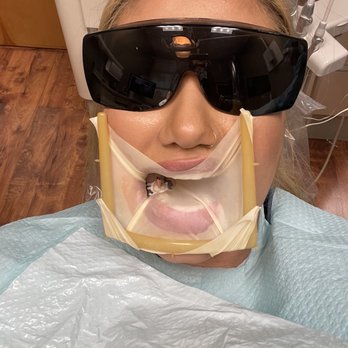 Endodontic Associates Dental Group - During root canal - Endodontists Near Me - Sacramento, California Endodontic Associates Dental Group - During root canal - Endodontists Near Me - Sacramento, California