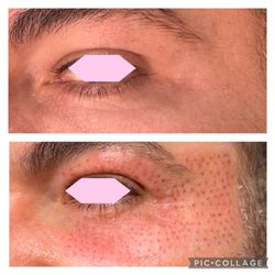 Revive Glam Fibroblast & Med Spa - Fibroblast for droopy eyelids, crowsfeet, and eye bags