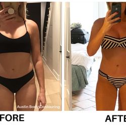Austin Body Contouring - Austin Body Contouring Client Before & After
