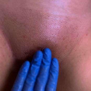 Mixed Esthetics - Brazilian Wax - Waxing Near Me - San Diego, California