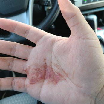 Sichuan Impression - Blood from my accident at the restaurant. - Szechuan Near Me - Alhambra, California