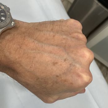 The Laser Image - Before - Skin Care Near Me - Redondo Beach, California