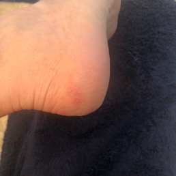 Hours after pedicure. Right heel where the redness is from the metal cheese-like grater she used. Extremely painful.
