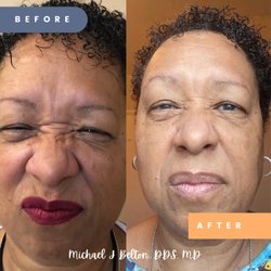 Before and after bunny lines.