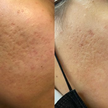 Glorify MedSpa - Acne scars before and after 2 Treatments with Miracle Verde' cream - Laser Hair Removal Near Me - Santa Ana, California Glorify MedSpa - Acne scars before and after 2 Treatments with Miracle Verde' cream - Laser Hair Removal Near Me - Santa Ana, California