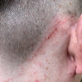 1857 Parlor - EZCuts cut both sides of my head making it bleed everywhere - Barbers Near Me - Anaheim, California 1857 Parlor - EZCuts cut both sides of my head making it bleed everywhere - Barbers Near Me - Anaheim, California