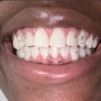Gems Teeth Whitening - My daughter's teeth are 8 shades whiter and BLINGEDDD OUUTT!!!! - Teeth Whitening Near Me - Spring, Texas Gems Teeth Whitening - My daughter's teeth are 8 shades whiter and BLINGEDDD OUUTT!!!! - Teeth Whitening Near Me - Spring, Texas