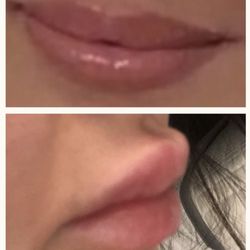 Lips Boutique by J.K.A. - Filler was improperly injected into moustache area rather than lips. Took multiple dissolvings/ lips are ruined (Top pic is before filler)
