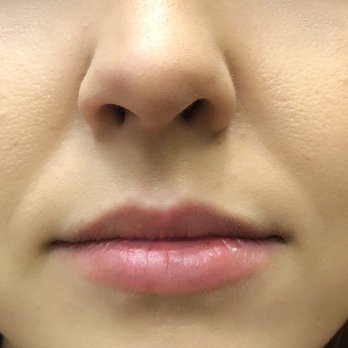 Jeff Healy, MD - Before - Cosmetic Surgeons Near Me - Aiea, Hawaii